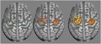 Quantification of tumor induced motor cortical plasticity using navigated transcranial magnetic stimulation in patients with adult-type diffuse gliomas